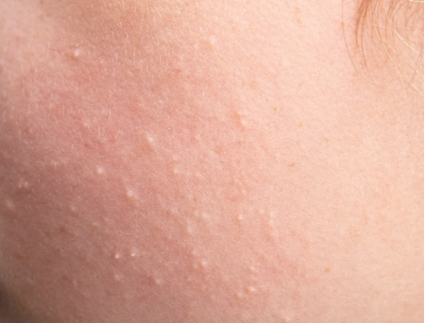 Why Proper Diagnosis Is Important for White Spots on a Child’s Face
