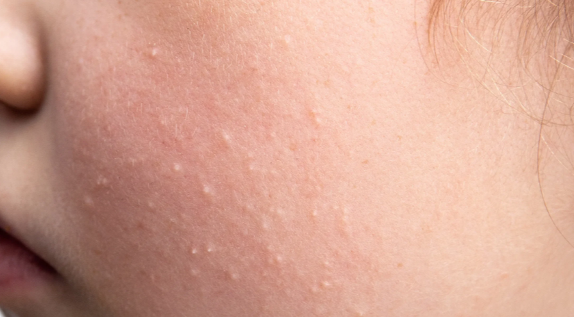 Why Proper Diagnosis Is Important for White Spots on a Child’s Face